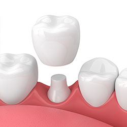 dental crown illustration