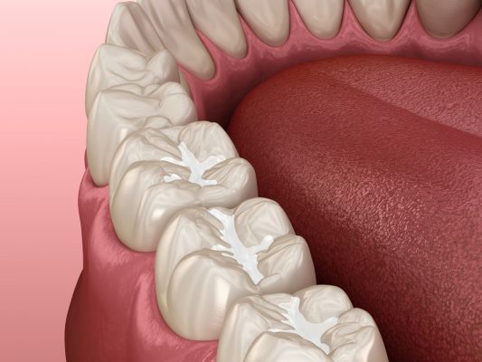 digital image of composite fillings in teeth